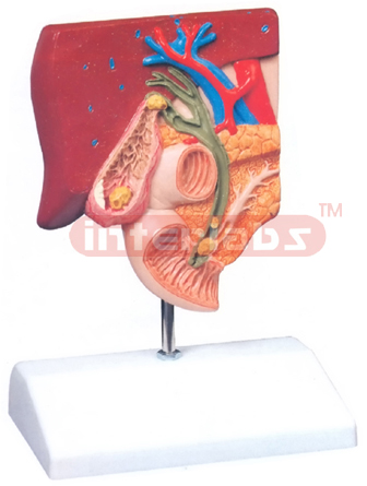 GALLSTONE